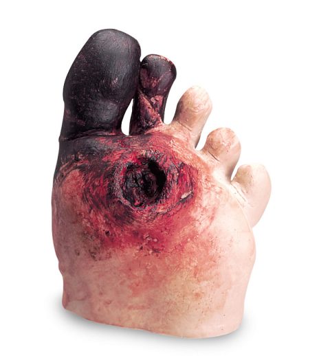 Diabetisch Voetmodel