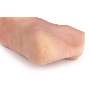 Diabetische Voet Model