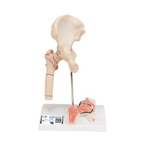 Dijbeenbreuk en hiposteoarthritis