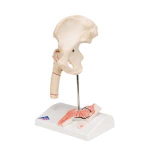 Dijbeenbreuk en hiposteoarthritis