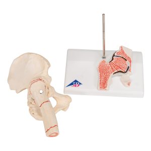 Dijbeenbreuk en hiposteoarthritis