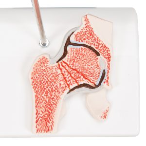 Dijbeenbreuk en hiposteoarthritis