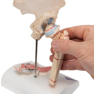 Dijbeenbreuk en hiposteoarthritis