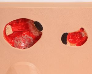 Doorligwonden Model