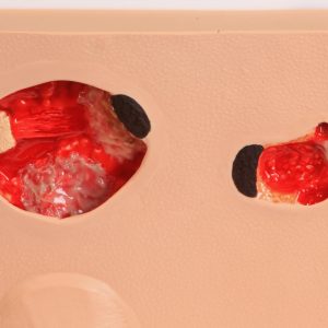 Doorligwonden Model