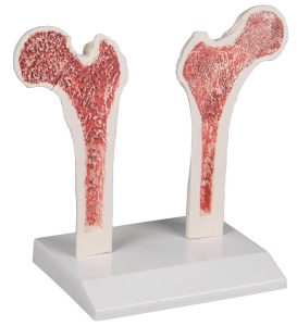 Doorsnede Dijbeen met Osteoporose