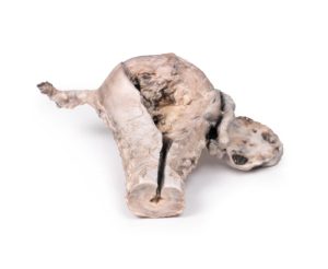 Endometriumcarcinoom, 3D Print
