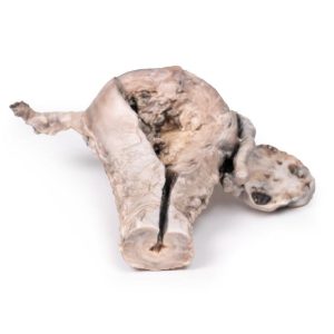 Endometriumcarcinoom, 3D Print