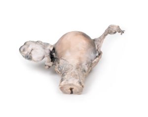 Endometriumcarcinoom, 3D Print