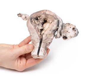 Endometriumcarcinoom, 3D Print