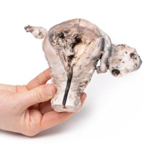 Endometriumcarcinoom, 3D Print