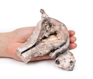 Endometriumcarcinoom, 3D Print