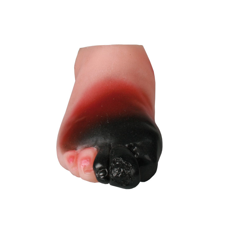 Ernstige Diabetesvoet