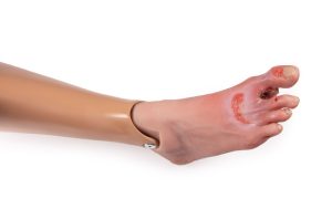 Ernstige Diabetische Voet voor Oefenpop