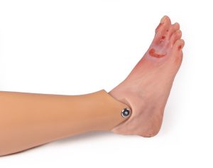 Ernstige Diabetische Voet voor Oefenpop