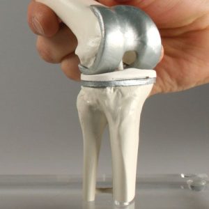 Knie-implantaat model