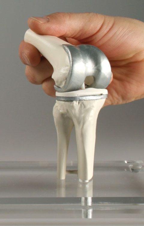 Knie-implantaat model