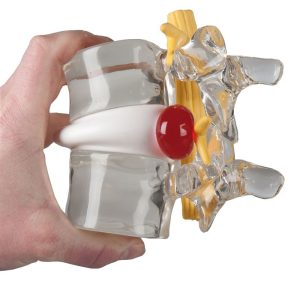 Demonstratie Lumbale Hernia, 2x ware grootte