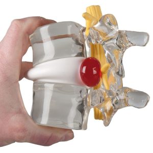 Demonstratie Lumbale Hernia, 2x ware grootte