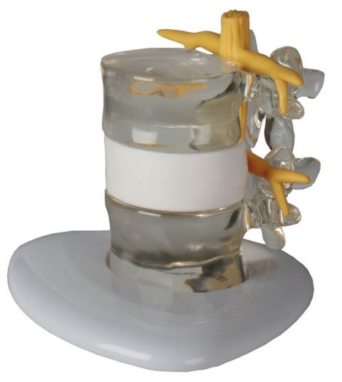 Demonstratie Lumbale Hernia, 2x ware grootte
