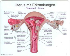 Baarmoeder met ziektebeelden