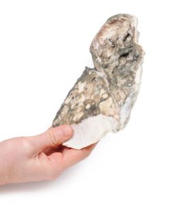 Fibreuze Tuberculose, 3D Print