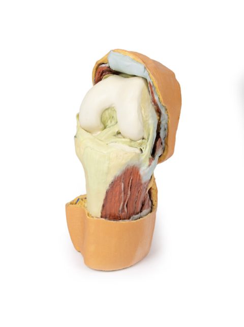 Gebogen knie met diepe dissectie, 3Dprint