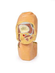 Gebogen knie met diepe dissectie, 3Dprint
