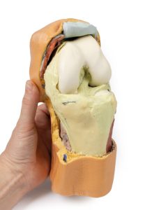 Gebogen knie met diepe dissectie, 3Dprint