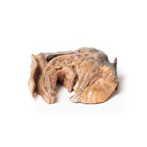Geïnhaleerd Vreemd Lichaam - Luchtpijp, 3D Print