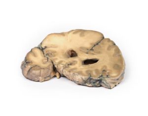 Gemetastaseerd Adenocarcinoom in de Hersenen, 3D Print