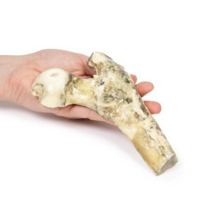 Gemetastaseerd Maligne Melanoom, 3D Print