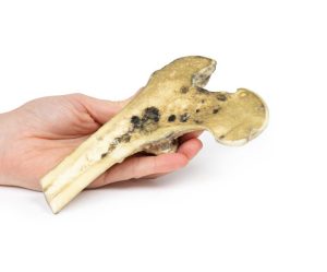 Gemetastaseerd Maligne Melanoom, 3D Print