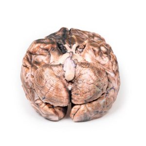 Gescheurd Sacculair Aneurysma, 3D Print