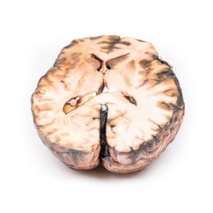 Gescheurd Sacculair Aneurysma, 3D Print