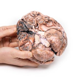 Gescheurd Sacculair Aneurysma, 3D Print
