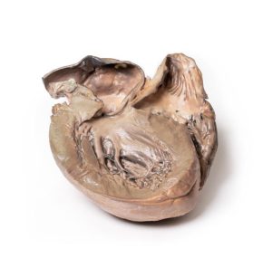 Gescheurd Thoracaal Aorta Aneurysma, 3D Print