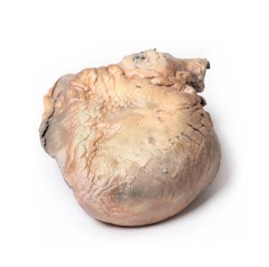 Gescheurd Thoracaal Aorta Aneurysma, 3D Print