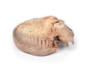 Gescheurd Thoracaal Aorta Aneurysma, 3D Print