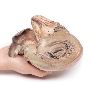 Gescheurd Thoracaal Aorta Aneurysma, 3D Print