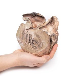 Gescheurd Thoracaal Aorta Aneurysma, 3D Print