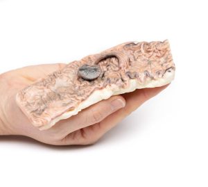 Gesteeld Adenoom in de Dikke Darm, 3D Print