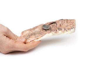 Gesteeld Adenoom in de Dikke Darm, 3D Print