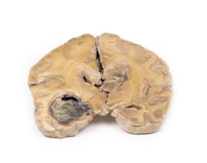Glioblastoma Multiforme, 3D Print