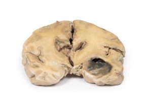Glioblastoma Multiforme, 3D Print