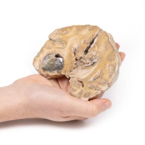 Glioblastoma Multiforme, 3D Print