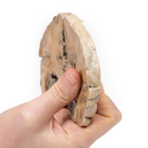Glioblastoma Multiforme, 3D Print