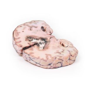 Glioom Graad 3-4, dat Papiloedeem veroorzaakt, 3D Print