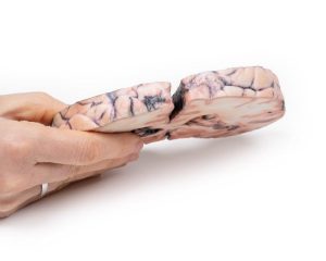 Glioom Graad 3-4, dat Papiloedeem veroorzaakt, 3D Print