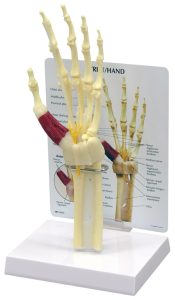 Hand/Pols met Carpaaltunnel syndroom